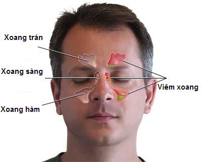 Khắc phục viêm xoang trán thế nào?