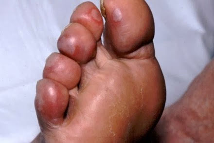 Cách chữa cước tay chân mùa đông tại nhà- Ảnh 2.