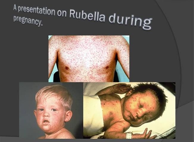 Rubella - Căn bệnh không thể xem nhẹ