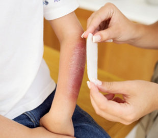 Nhiễm khuẩn vết thương, vết bỏng, chọn thuốc nào?