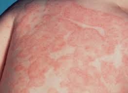Bệnh chàm dễ tăng ngụy cơ tim mạch và đột qụy