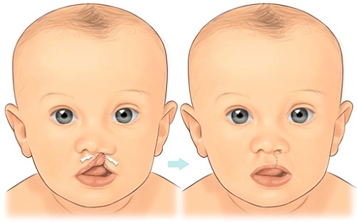 Trẻ bị khe hở môi - vòm miệng Khi nào cần phẫu thuật?