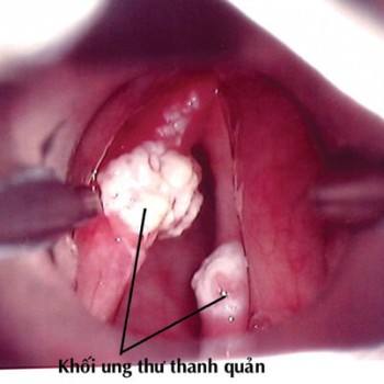 Viêm dây thanh quản dễ gẫn tới ung thư