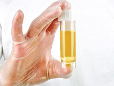 Tiểu ra máu và buốt, bệnh gì?