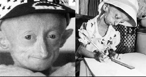 Trẻ nhỏ già đi như người già do bí ẩn gen lỗi trong hội chứng Progeria- Ảnh 3.