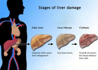 Triệu chứng điển hình của viêm gan do rượu- Ảnh 2.