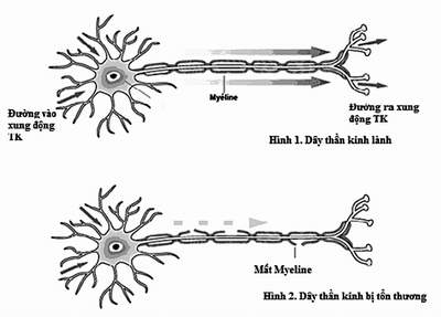 Tê tay chân liên tục cảnh giác với bệnh hiếm gây ảnh hưởng nghiêm trọng đến hệ thần kinh- Ảnh 2.