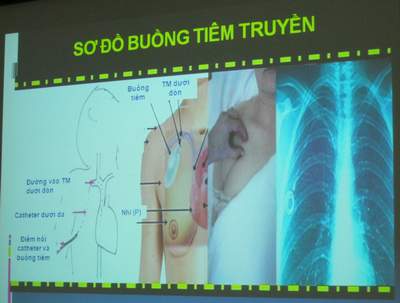 Hạn chế những biến chứng vì hóa trị ung thư - Cách gì?