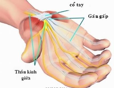 Hội chứng đường hầm cổ tay