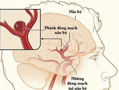 Điều trị dị dạng mạch máu não