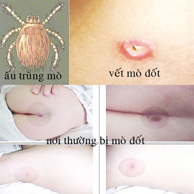 Cảnh giác với sốt mò