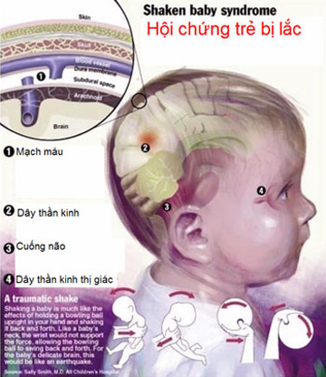 Cẩn thận hội chứng rung lắc ở trẻ