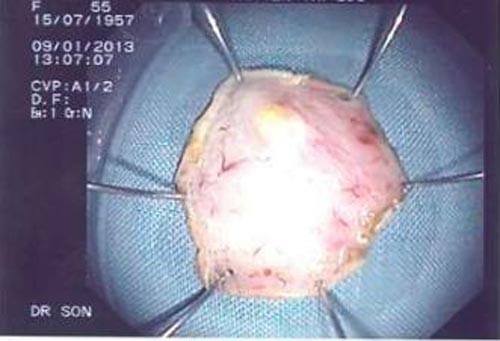 Lần đầu tiên cắt u dạ dày qua đường miệng