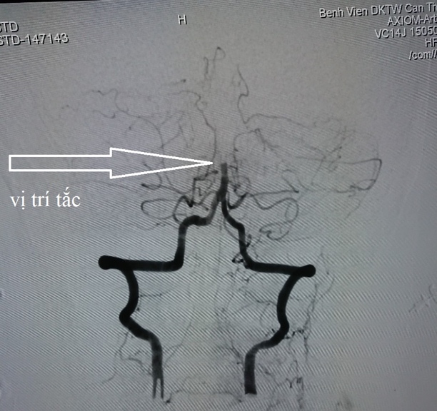 Hình ảnh mạch máu não trước khi can thiệp