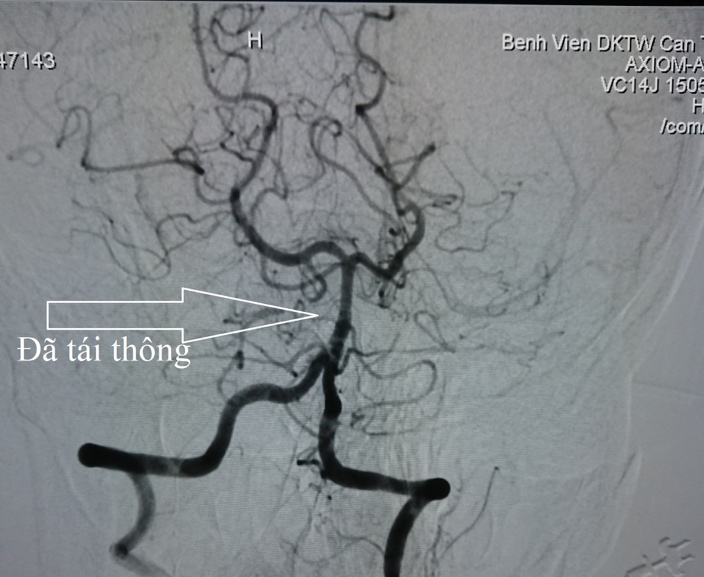 Hình ảnh mạch máu não sau can thiệp được chụp trên máy DSA