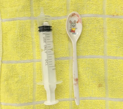 Cô gái 18 tuổi không may nuốt...trôi thìa nhựa