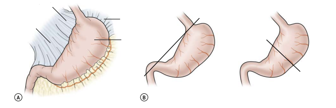 Bé trai 3 tháng tuổi mắc xoắn dạ dày hiếm gặp
