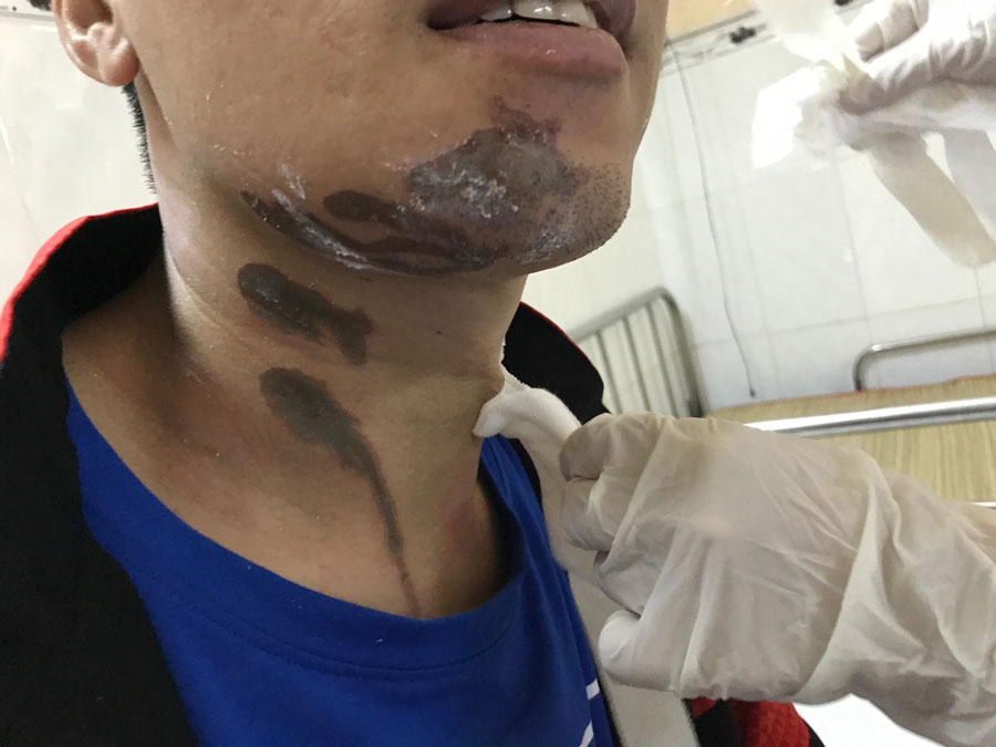 Dùng hóa chất xử trí tắc, bồn cầu phát nổ, người phụ nữ phải nhập viện vì bị bỏng nặng- Ảnh 2.