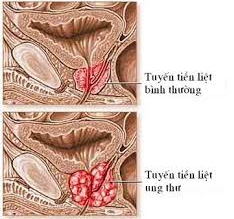 dau-hieu-nhan-biet-ung-thu-tien-liet-tuyen