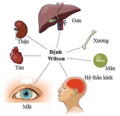 So-do-benh-Wilson-anh-huong-toi-cac-co-quan-trong-co-the