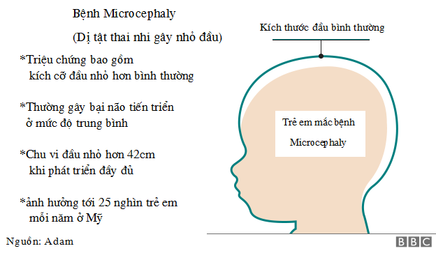 Bệnh dị tật thai nhi gây nhỏ đầu Microcephaly Di-tat-thai-nhi-microcephaly-khien-dau-nho-va-moi-lien-he-voi-Virus-Zika