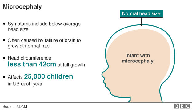 Bệnh dị tật thai nhi gây nhỏ đầu Microcephaly di-tat-thai-nhi-Microcephaly-gay-benh-nho-dau