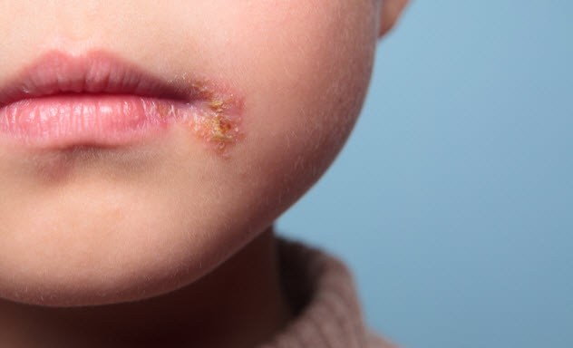 Trien-vong-dieu-tri-benh-nan-y-herpes
