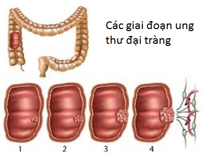 ung thư đại tràng