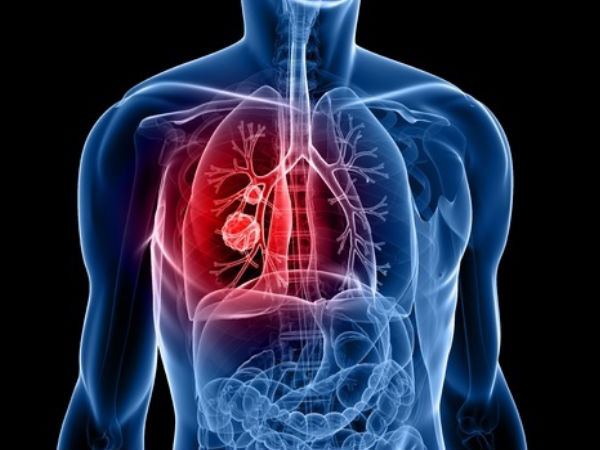Vitamin B có thể làm tăng nguy cơ ung thư phổi ở nam giới