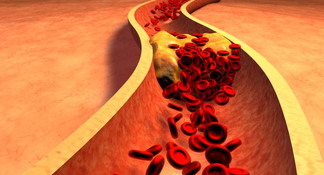 Cholesterol cao cản trở máu lưu thông tới tim