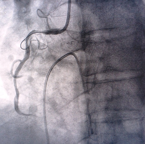 Hình ảnh đặt stent động mạch vành cho bệnh nhân 