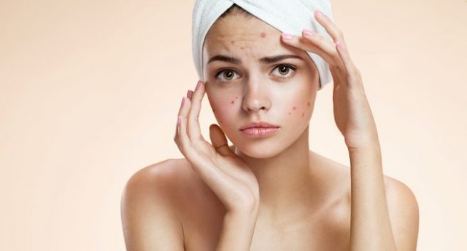 Mụn trứng cá làm tăng nguy cơ trầm cảm