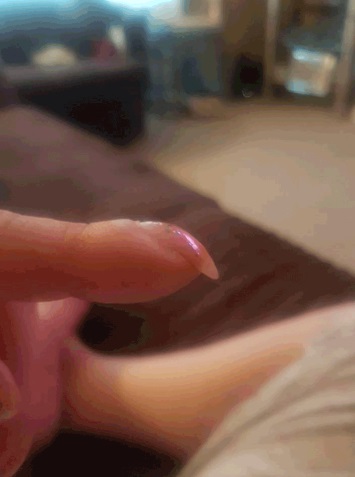 Hình ảnh móng tay cong của bà Jean Taylor dẫn đến chẩn đoán ung thư phổi