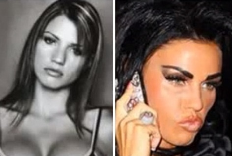 Katie Price trước và sau khi chỉnh hình