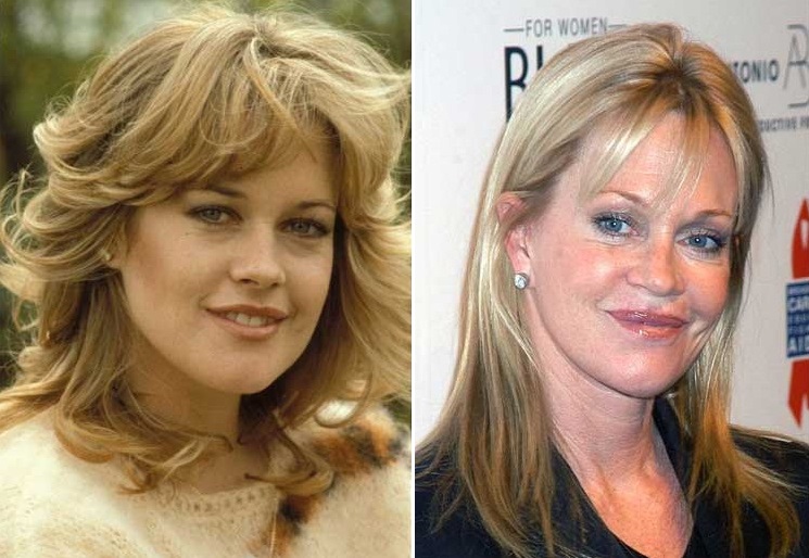 Do tiêm botox, Melanie Griffith đã biến gương mặt 