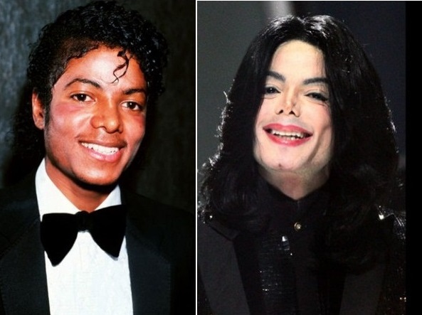 Michael Jackson phải tạm dừng ca hát nhiều năm để điều trị tai biến thẩm mỹ