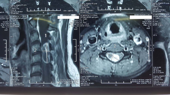 Hình ảnh chụp Cộng hưởng từ (MRI) khối u tủy cổ
