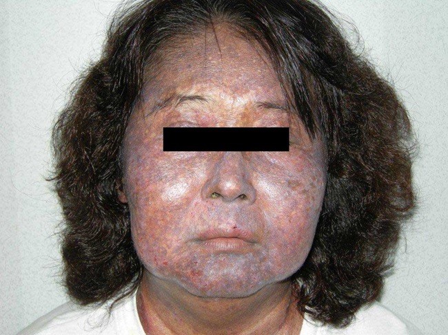 Người mắc hội chứng Ochronosis