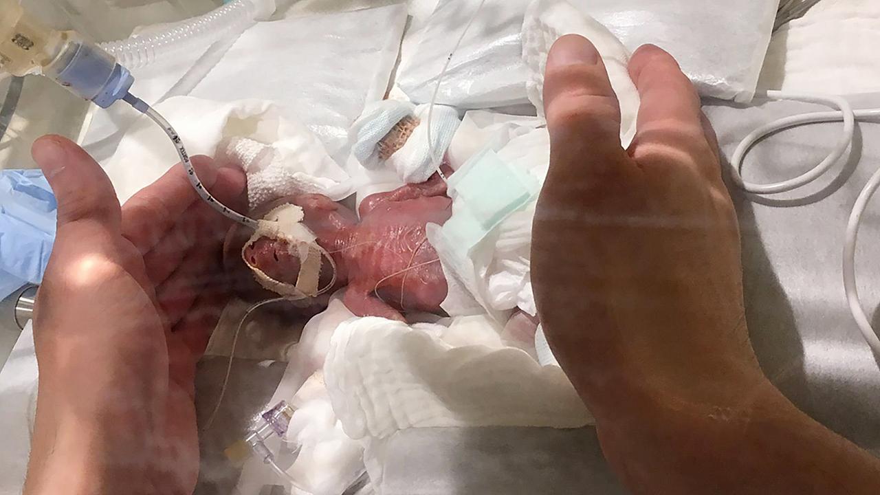 Bé sơ sinh nhỏ nhất thế giới - Khi mới ra đời, bé nặng chưa đầy 3 lạng