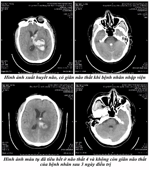 Hình ảnh chụp cắt lớp sọ não của bệnh nhân sau khi điều trị tích cực bằng phương pháp dẫn lưu não thất kết hợp dùng thuốc tiêu sợi huyết