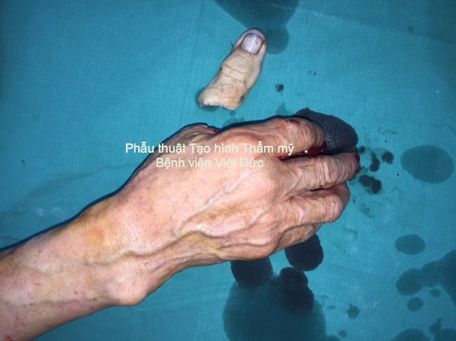 Kỳ diệu vi phẫu nối liền ngón cái đứt rời cho người lớn tuổi nhất từ trước tới nay_Ngón tay cái của bệnh nhân bị máy cưa cắt đứt rời