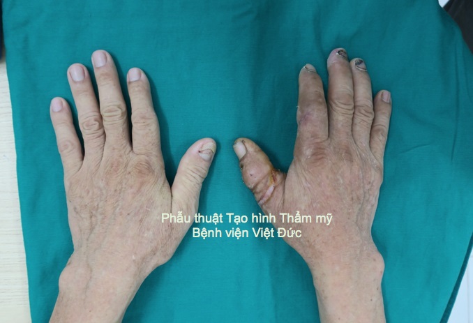 Bàn tay trở nên nguyên vẹn sau 5 tuần vi phẫu nối ngón tay cái đứt rời