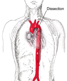 Bóc tách động mạch chủ (dissection aortique): (1) Động mạch chủ lên; (2) Quai động mạch chủ; (3) Động mạch chủ xuống; (4) Động mạch chủ bụng.