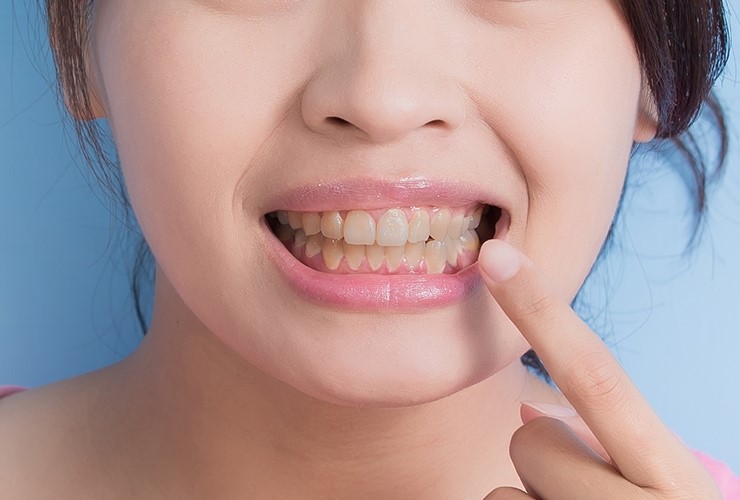 Uống thuốc kháng sinh có làm răng ố vàng?