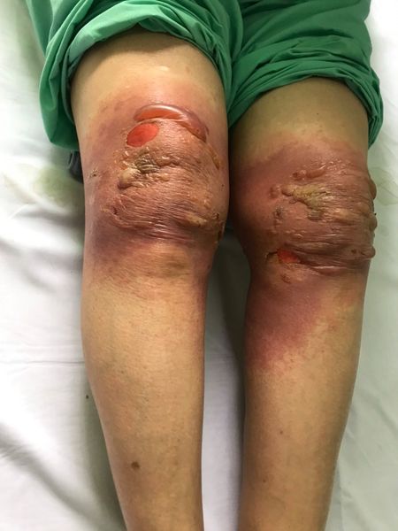 Sau đắp lá chữa đau khớp, một phụ nữ bị bỏng 2 đầu gối