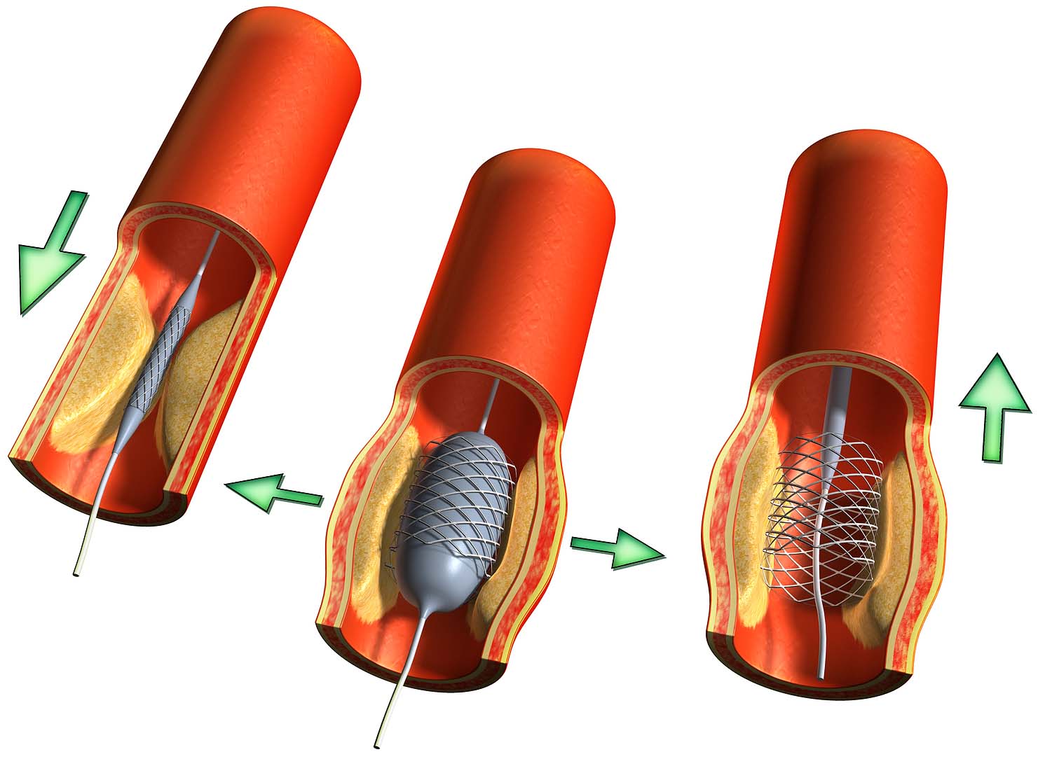 Bệnh nhân đặt stent động mạch vành: Vì sao cần dùng kháng tiểu cầu kép?