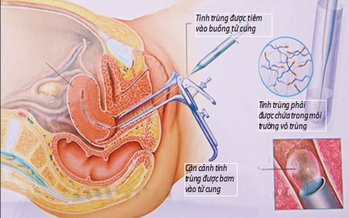 Các phương pháp thay thế IUI