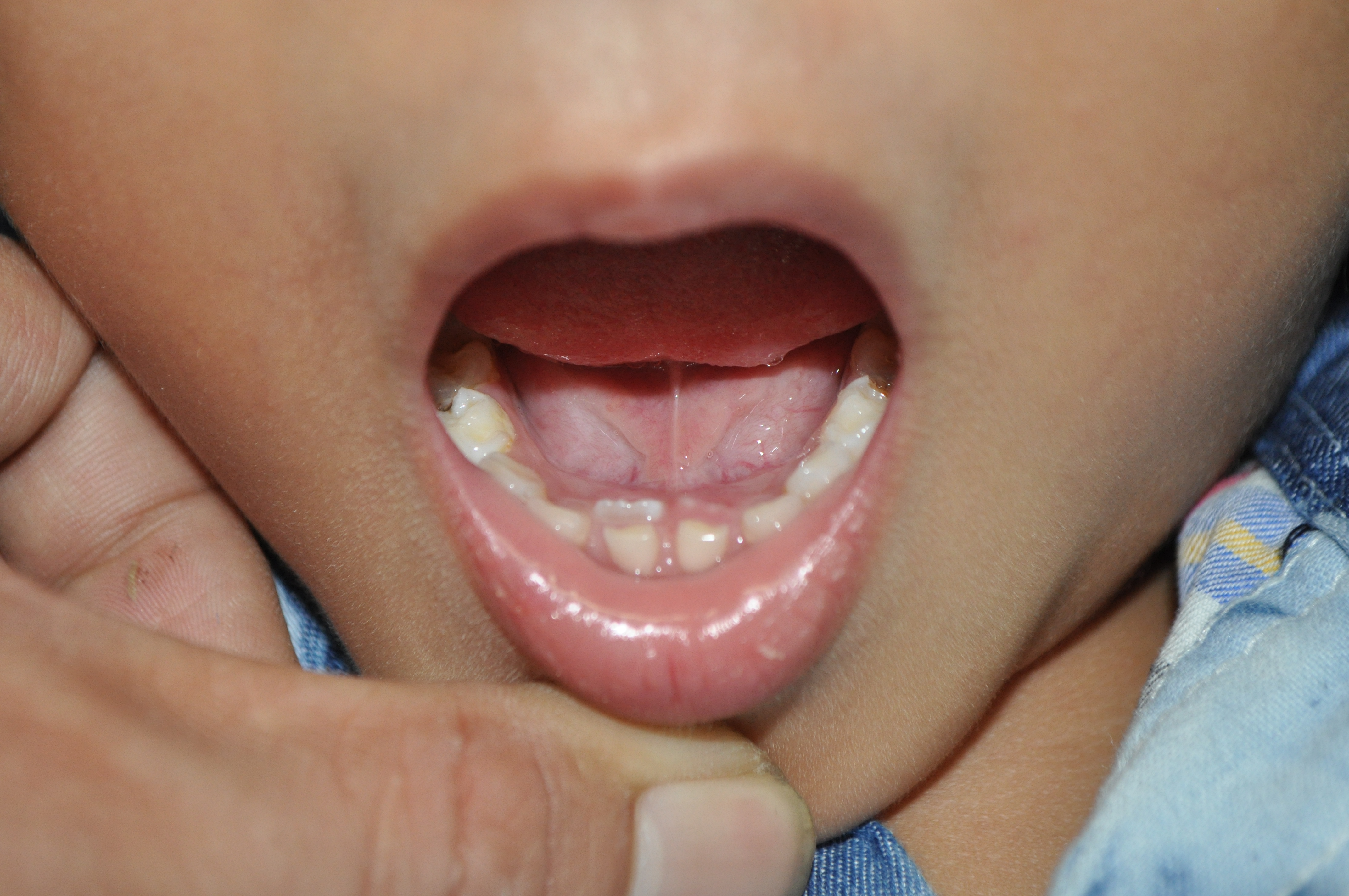 Làm gì khi răng vĩnh viễn mọc lệch do răng sữa không “rung rinh”?