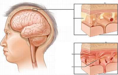 Lao màng não - Thể lao nguy hiểm