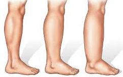 Chân voi là bệnh gì, có nguy hiểm không?- Ảnh 2. Bệnh chân voi và khuyến cáo mới